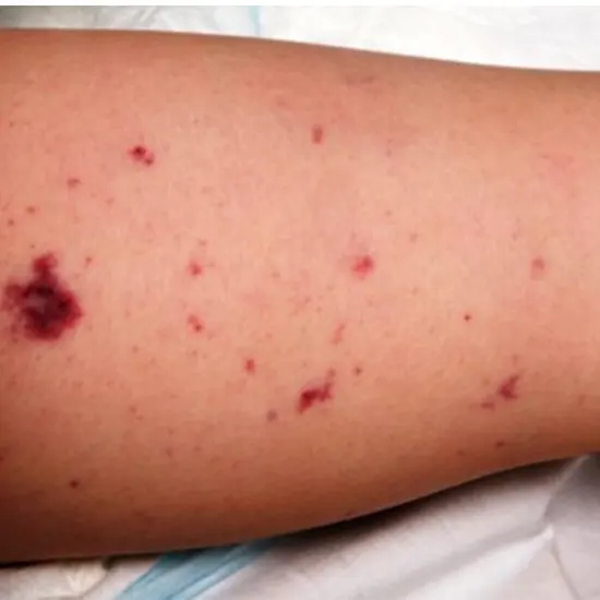 Meningococcal Disease